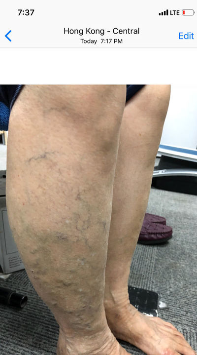 Continued improvement on the patient suffering varicose vein with regular LymphaCARE treatments.