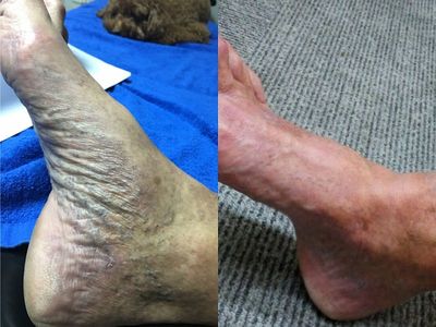 Instant improved blood circulation on a diabetic foot after just one treatment
