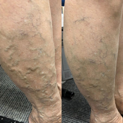 Significant improvement on the legs of a patient suffering varicose vein after her first treatment with LymphaCARE