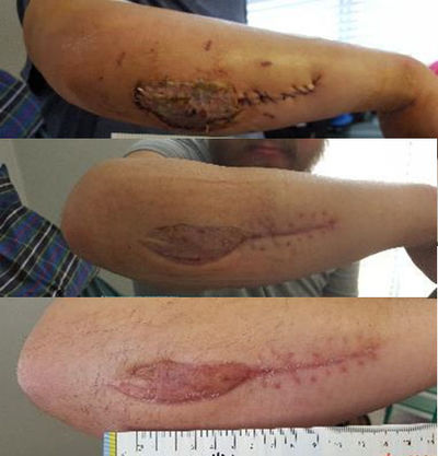 Improved blood circulation has led to quicker wound healing on this patient receiving LymphaCARE A.N.S treatments